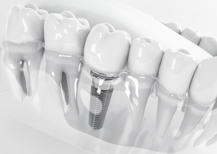 implant dentar