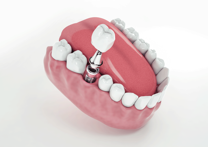 implant dentar timisoara
